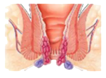 HAPROS - bare medical laser fiber