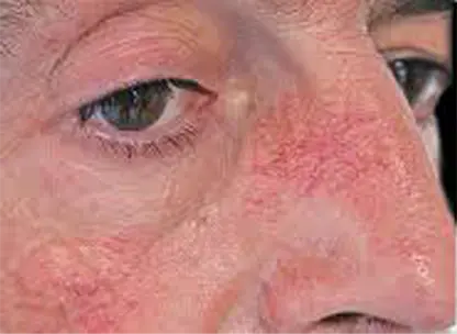 Hapros offers spider vein treatment laser machine