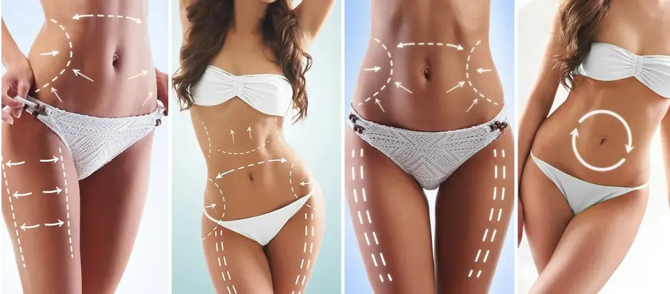 Laser Liposuction: Precise Fat Removal and Skin Tightening in One Step